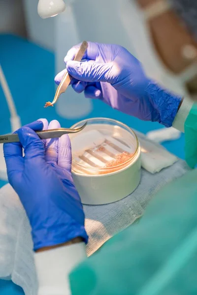 Волосатый Хирург Выбирает Фолликулярные Единицы Пинцетом Трансплантации Волос Крупный План — стоковое фото