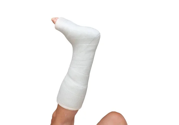 Ein Gebrochenes Bein Der Frau Isoliert Und Mit Medizinischem Verband — Stockfoto