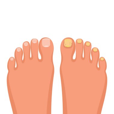 Nail disease. Onychomycosis concept. Fungal nail infection. Paronychia is inflammation of the skin around the toenail. Fungal disease, psoriasis. Vector illustration flat design.  clipart