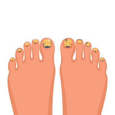 Tırnak hastalığı. Onikomikozis konsepti. Mantar tırnağı enfeksiyonu. Paronychia, ayak tırnağının etrafındaki deri iltihabıdır. Mantar hastalığı, sedef hastalığı. Vektör illüstrasyon düz tasarım.