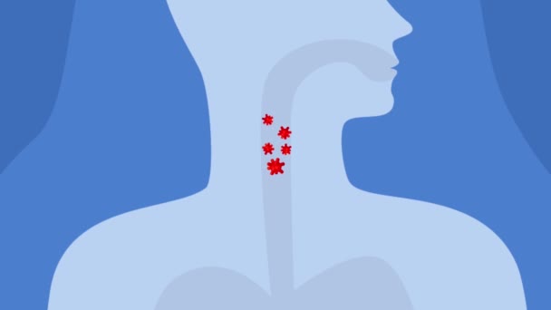 Animation Πονόλαιμο Βακτήρια Στο Λαιμό Ασθένεια Κρύος Ιός Γρίπης — Αρχείο Βίντεο