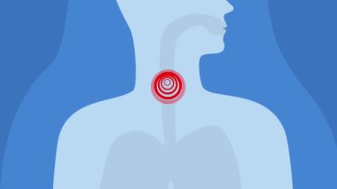 Boğaz ağrısı ya da boğaz ağrısı. Hastalık, soğuk algınlığı ya da grip virüsü.