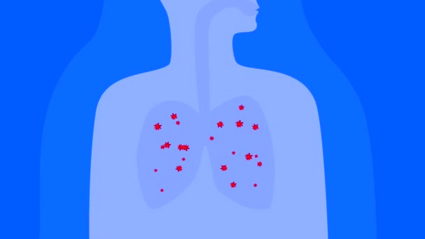 Animazione Malattie Polmonari Del Sistema Respiratorio Coronavirus Batteri Nei Polmoni — Video Stock