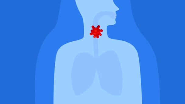 Boğaz Ağrısı Boğaz Ağrısı Hastalık Soğuk Algınlığı Grip Virüsü Yüksek — Stok video