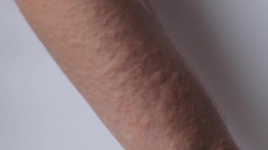 Kolunda döküntü, ürtiker, alerji, büyük bir klanın deri hastalıkları. Papüle, sivilce. Yüksek kalite 4k görüntü