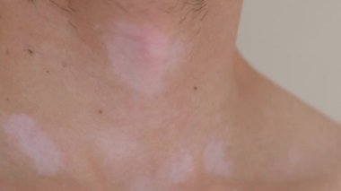 Vitiligo yakın plan insan derisi. Yüksek kalite 4k görüntü