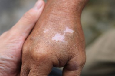 Vitiligo derisinin renginin değişmesiyle yaşlı adamın ellerini yakın plan çek. Mevsimsel cilt koşullarında bir yaşam biçimi. Vitiligo, deride yamalara neden olan bir durum, mücadele ve çabanın bir sembolüdür..