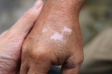 Close-up of old man's hands with vitiligo skin discoloration. a way of life with seasonal skin conditions. Vitiligo, a condition that causes patches on the skin, is a symbol of struggle and effort. clipart