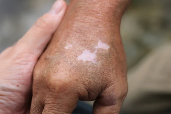 Vitiligo Derisinin Renginin Değişmesiyle Yaşlı Adamın Ellerini Yakın Plan Çek Stok Fotoğraf