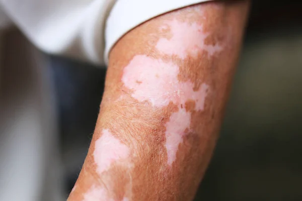 Vitiligo Derisinin Renginin Değişmesiyle Yaşlı Adamın Ellerini Yakın Plan Çek Telifsiz Stok Imajlar