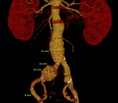 Abdominal aort infrarenal iliak arter anevrizması..