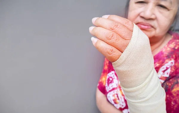 The concept of a broken arm. A cast broken arm for immobilization after an injury to the arm and hand. The woman\'s hand is wrapped in a bandage.