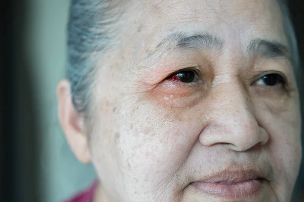 Diseases of the retina of the eye. Close-up of older female eyes with red inflamed and dilated capillaries. Hemorrhage under the conjunctiva. Conjunctivitis, keratitis, dry eye syndrome, trauma, uveitis