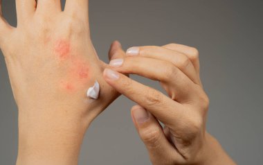 Kadının eline nemlendirici krem sürerken çekilmiş görüntüsü, kuru cilt için, sedef, egzama ve diğer kuru cilt hastalıklarının tedavisi gibi.