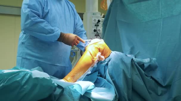 Cirujano Está Trabajando Pierna Los Pacientes — Vídeo de stock