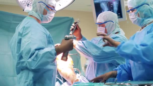 外科医は手術中に患者の手足に取り組んでいます — ストック動画