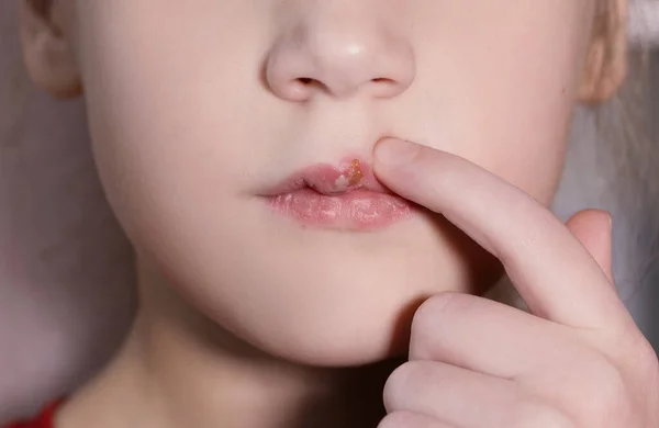 Children\'s herpes virus on the lip of a sick girl. The child points a finger at the wound on the upper lip. Close-up of the disease