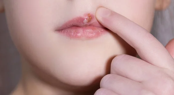 Children\'s herpes virus on the lip of a sick girl. The child points a finger at the wound on the upper lip. Close-up of the disease
