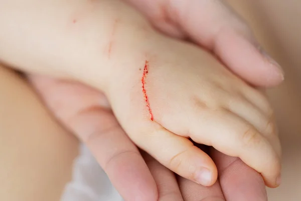 Severe Wound Child Hand Animal Bit Scratched Small Child Hand — Φωτογραφία Αρχείου