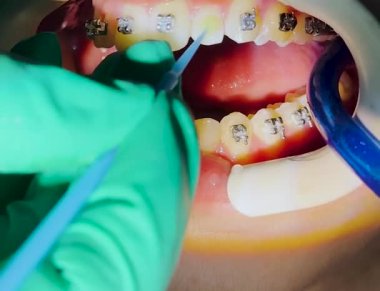 Beyaz dişli, parantezli bir kadına yaklaş. Diş aynası ve pens kullanan ortodontist hasta dişlerine diş teli takıyor. Stomatoloji, dişçilik, ortodontik tedavi kavramı