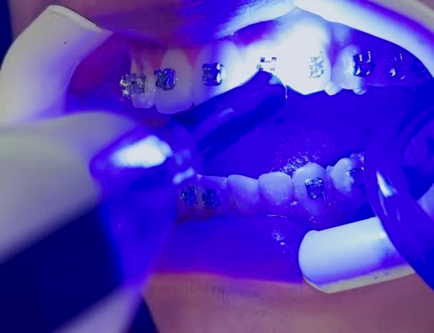 Размещение Фиксированного Гонорара Процессе Удаления Зубных Скобок Девушки Стоматологической Клинике — стоковое видео