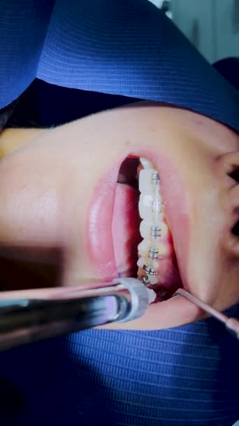 Sequência Colocação Folheados Dentários Fechar Etapas Clínicas Intra Orais Superior — Vídeo de Stock