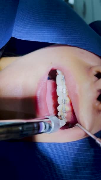 Colocando Retentor Fixo Processo Remoção Aparelhos Dentários Uma Menina Uma — Vídeo de Stock
