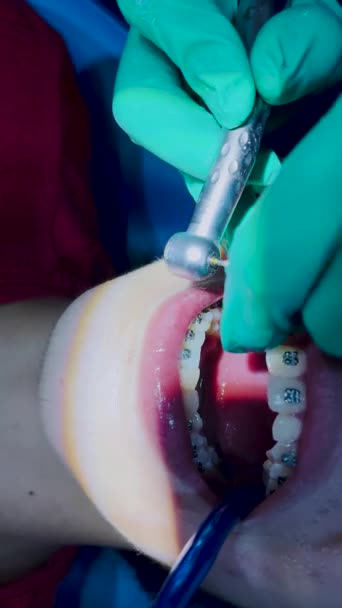 在白牙上有括号的女人的近视 牙齿矫正医生使用牙镜和钳 同时在病人的牙齿上戴上正牙托 口腔学 牙科学 牙齿矫正治疗的概念 — 图库视频影像