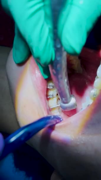 Menutup Wanita Dengan Tanda Kurung Gigi Putih Dokter Gigi Menggunakan — Stok Video