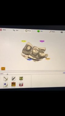 Modern CAD Software Used For Dentistry Prosthetic Project Making. Applying Prosthetic Dentistry Restoration To Damaged Teeth In Software. Prosthetic Dentistry In 3D Modeling Software Interface