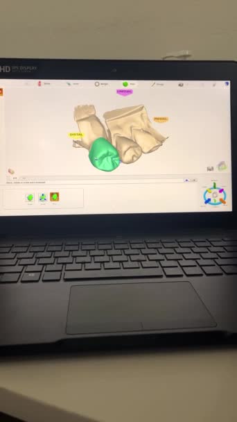 Modern Cad Software Used Dentistry Prosthetic Project Making Applying Prosthetic — Stockvideo