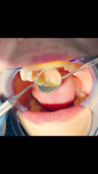 Młoda Dentystka Przyjęcie Ortodonty Wymiana Aparatu Zęby Polerowanie Wiązanie Żelowe — Wideo stockowe