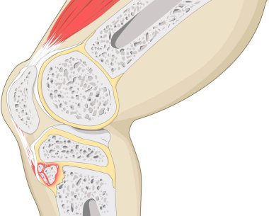 Osgood-Schlatter Hastalığı: Bu illüstrasyon rehberi, ergenlikte yaygın bir diz rahatsızlığı olan Osgood-Schlatter hastalığını özetliyor. Anatomik yönleri vurgular, tibiyal tüberkülozdaki iltihabı vurgular..