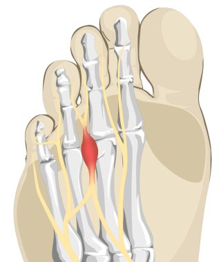 Foot nerve inflammation, or neuritis, is a condition where nerves in the foot become irritated, causing pain, tingling, and discomfort. Common causes include injury, compression, or underlying conditions.  clipart