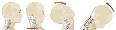 Whiplash genellikle araba kazalarında görülen ani ileri geri hareketlerin yol açtığı bir boyun yaralanmasıdır. Belirtileri boyun ağrısı, kasılma ve baş ağrıları. Ani tıbbi müdahale, ağrıyı azaltmak için teşhis ve tedavi için çok önemlidir..