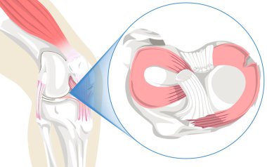The Torn Meniscus illustration vividly captures the intricate structures of the knee joint, showcasing the tear in the meniscus. With precision, it conveys the common injury's anatomy, aiding in a comprehensive understanding. clipart
