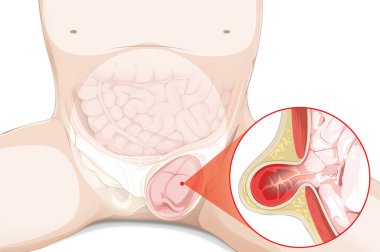Explore the intricacies of a hernia through this vivid illustration. Clearly depicting the displacement of an organ, this visual aid simplifies a complex medical condition, aiding in understanding and awareness. clipart