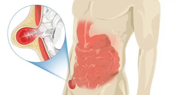 Stomach Pain Hernia Occurs Internal Organ Pushes Weak Muscles Causing — Stock Photo, Image