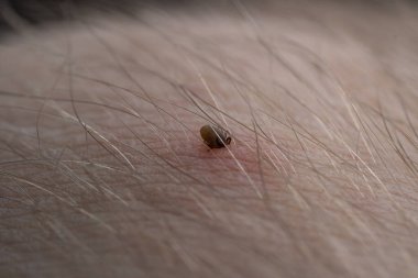 Sucking a tick Macro photo on human skin. Ixodes ricinus. The swollen parasite has bitten the irritated pink epidermis. Small red drops. Dangerous insect mite. Encephalitis, Lyme disease infection.