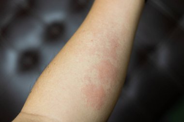 Alerjik dermatit egzama hastası derisi. Kaşındıran bir el, kaşındıran kırmızı bir nokta ya da deri döküntüsü. Sağlık Hizmetleri.