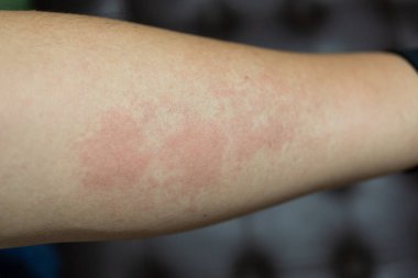 Alerjik dermatit egzama hastası derisi. Kaşındıran bir el, kaşındıran kırmızı bir nokta ya da deri döküntüsü. Sağlık Hizmetleri.
