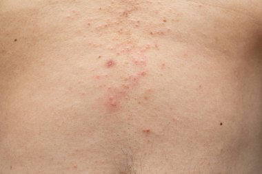 Midede egzama var. Alerji, atopikten kaynaklanan alerjik reaksiyon, kaşındıran bir el, kaşındıran kırmızı bir nokta ya da ciltte kızarıklık..