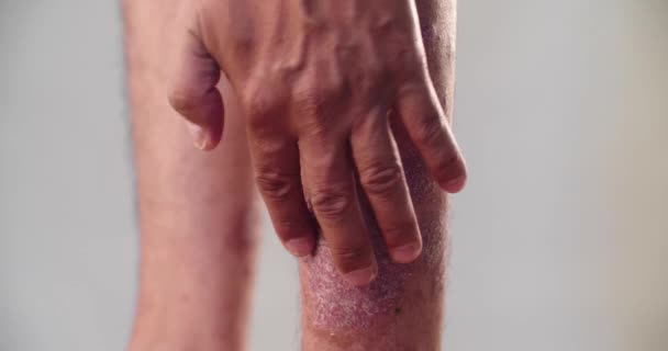 Близько Людини Подряпає Сверблячу Ногу Шкірними Захворюваннями Такими Алергія Дерматит — стокове відео