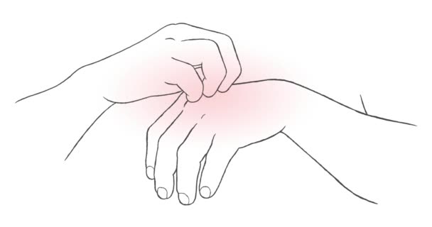 アレルギー 皮膚炎 乾燥したフレーク状の皮膚 真菌などの皮膚疾患でかゆみの手を掻く男のシルエットアニメーションの閉鎖 皮膚の問題の概念の救済 — ストック動画