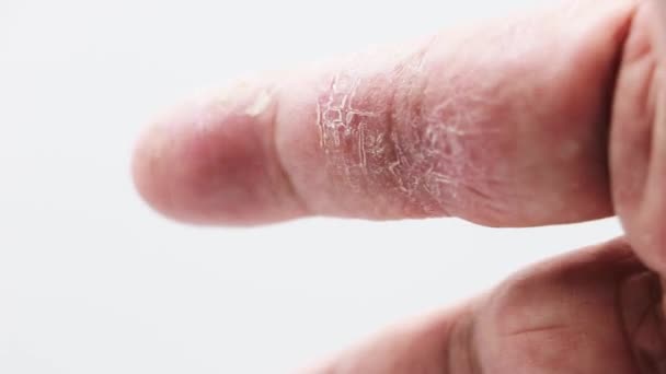 Close Index Finger Man Skin Disease Allergy Dermatitis Rash Dry — Stock Video