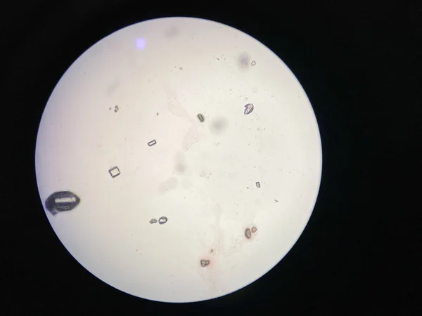 Mikroskopický Pohled Krystaly Struvitu Močového Sedimentu Krystaly Fosforečnanu Hořečnatého — Stock fotografie