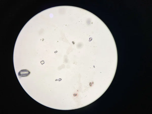 Mikroskopisk Bild Struvitkristaller Från Urinsediment Magnesiumammoniumfosfatkristaller — Stockfoto
