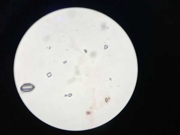 Vista Microscópica Cristales Estruvita Sedimentos Urinarios Cristales Fosfato Magnesio Amonio — Foto de Stock