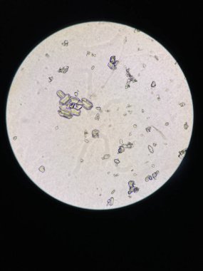 Microscopic view of struvite crystals from urinary sediment. Magnesium ammonium phospate crystals. Causing Feline Lower Urinary Tract Disease 