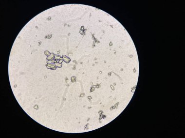 Microscopic view of struvite crystals from urinary sediment. Magnesium ammonium phospate crystals. Causing Feline Lower Urinary Tract Disease  clipart